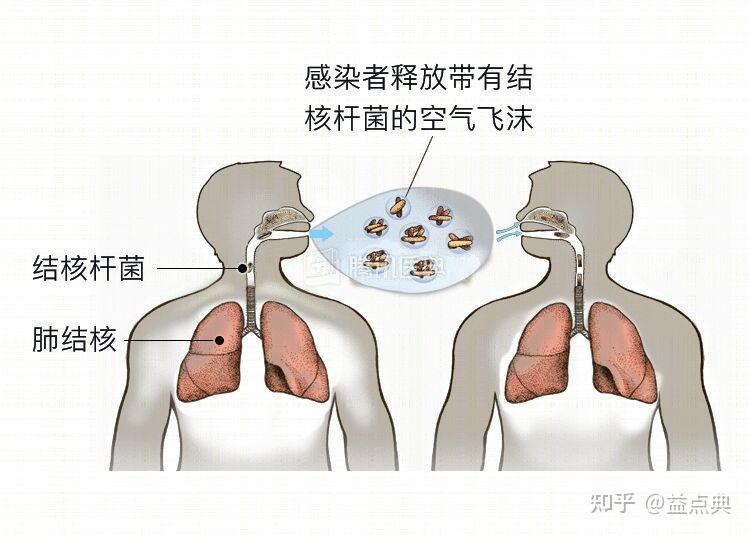 【慢病数据库】肺结核科普 - 知乎