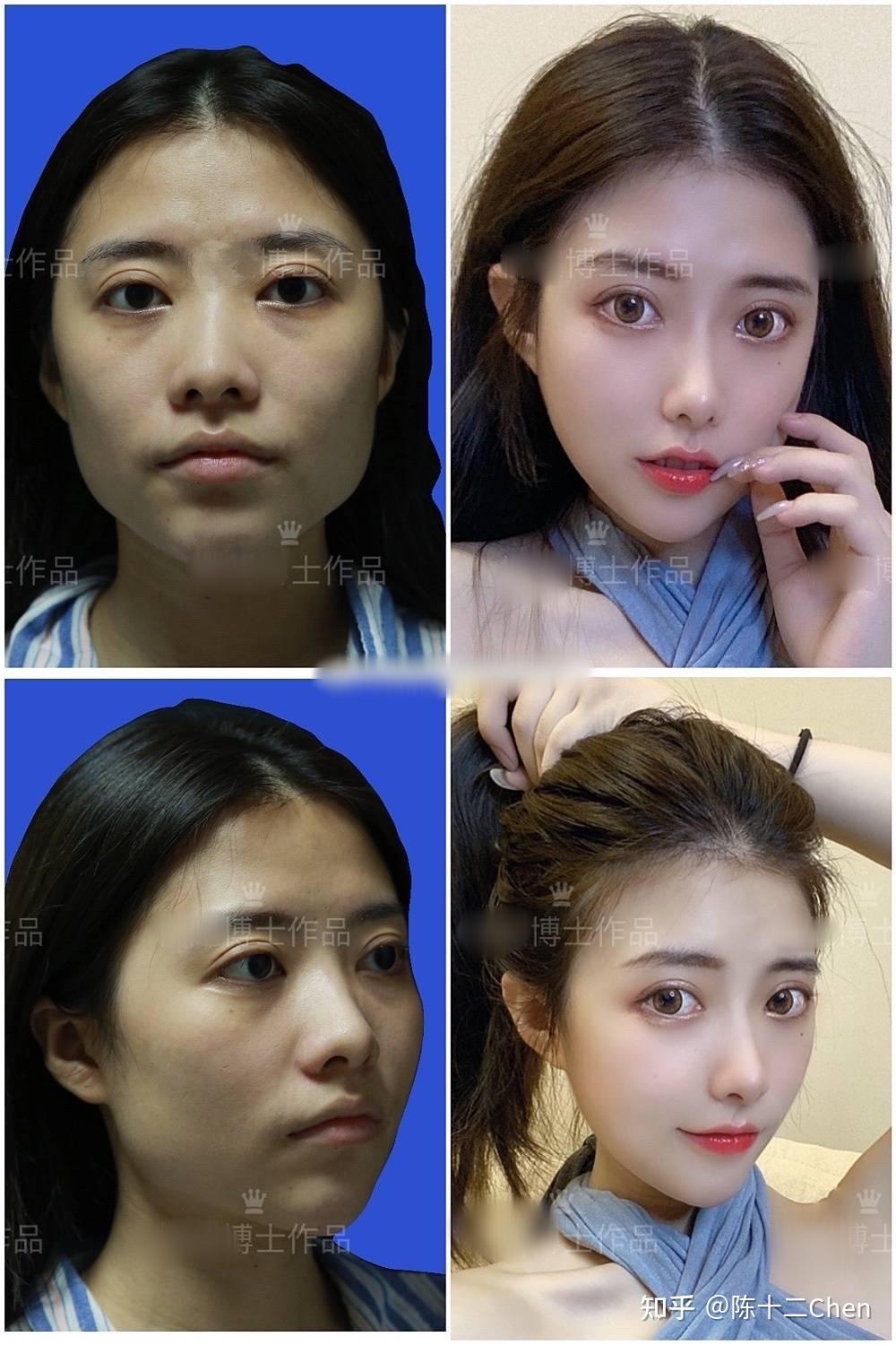 广州有磨骨手术资质的医院是哪几家