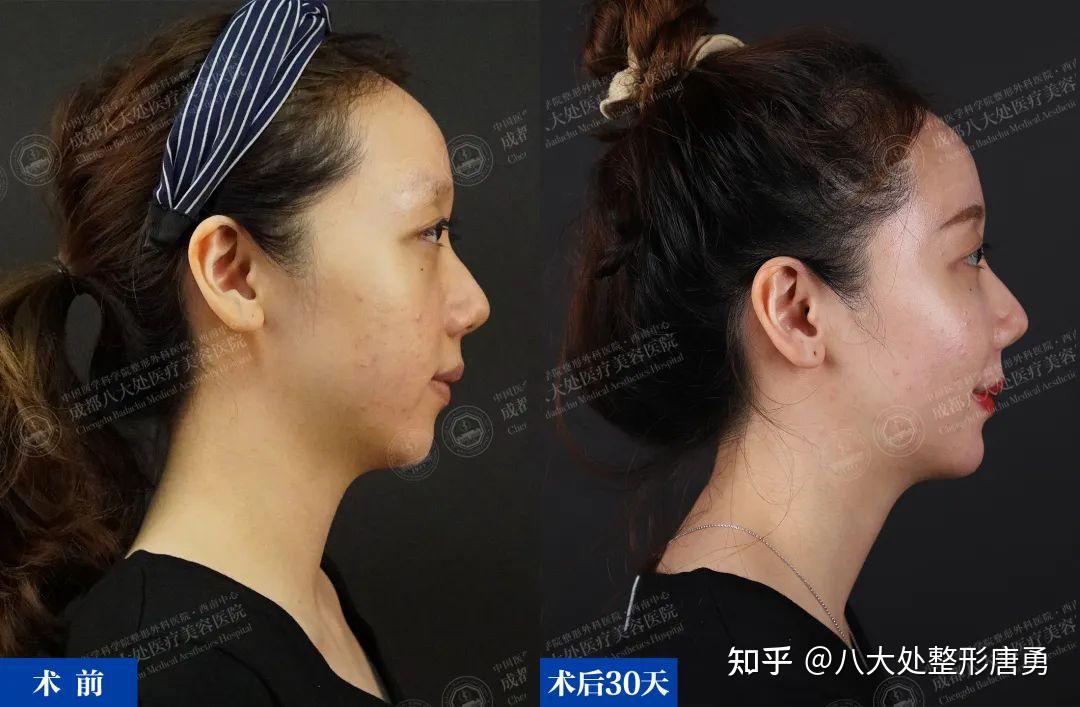 脸垮凹陷逆袭饱满少女脸，面部脂肪填充30天打卡 - 知乎