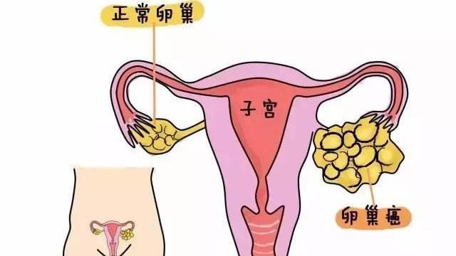 卵巢癌与乳腺癌 一对"孪生姐妹"