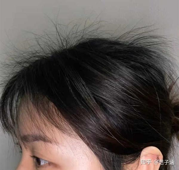 女生头发稀,发际线高,头发细软还掉头发怎么才能恢复正常。。。 - 知乎