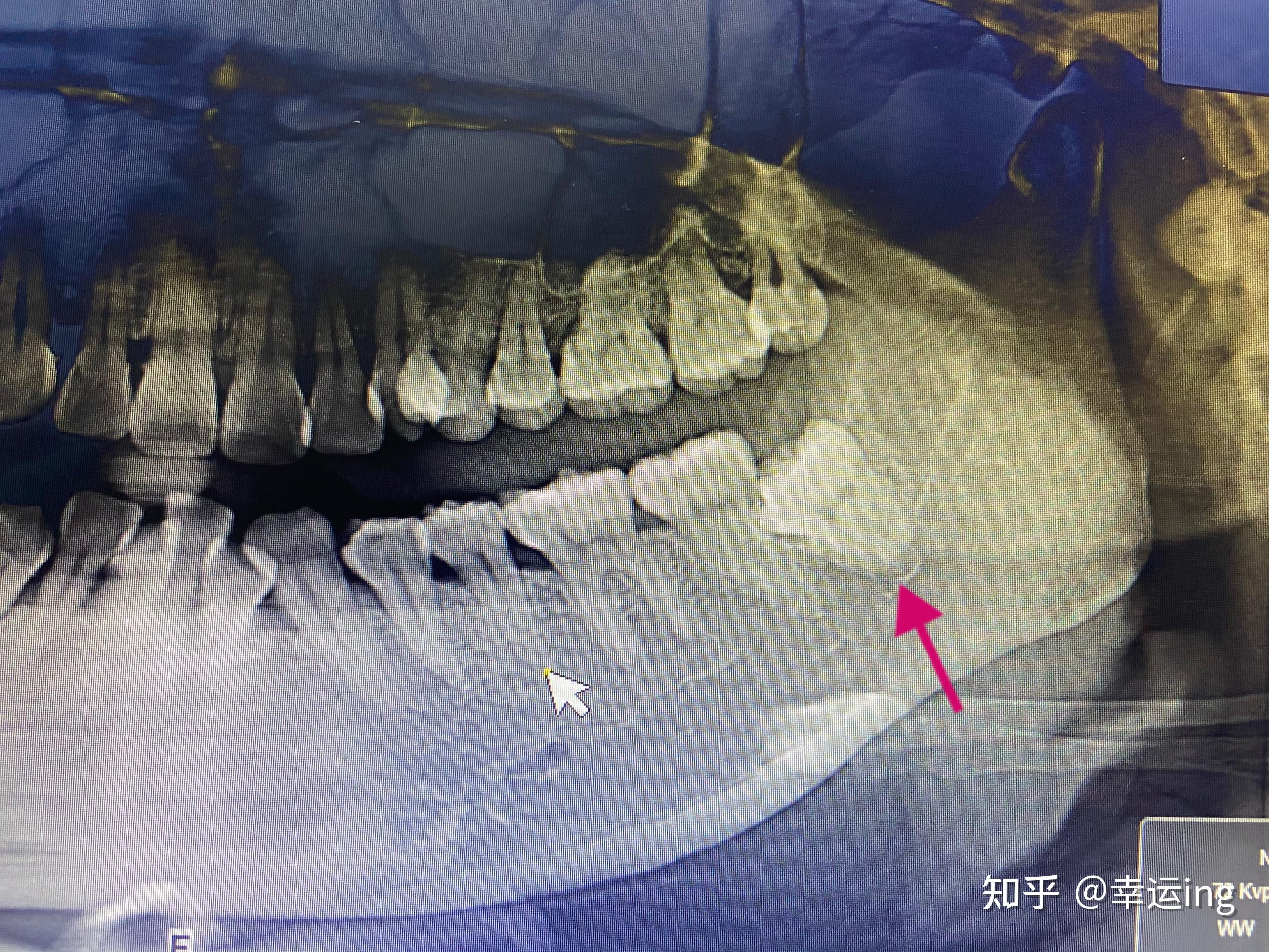 智齿神经管图片