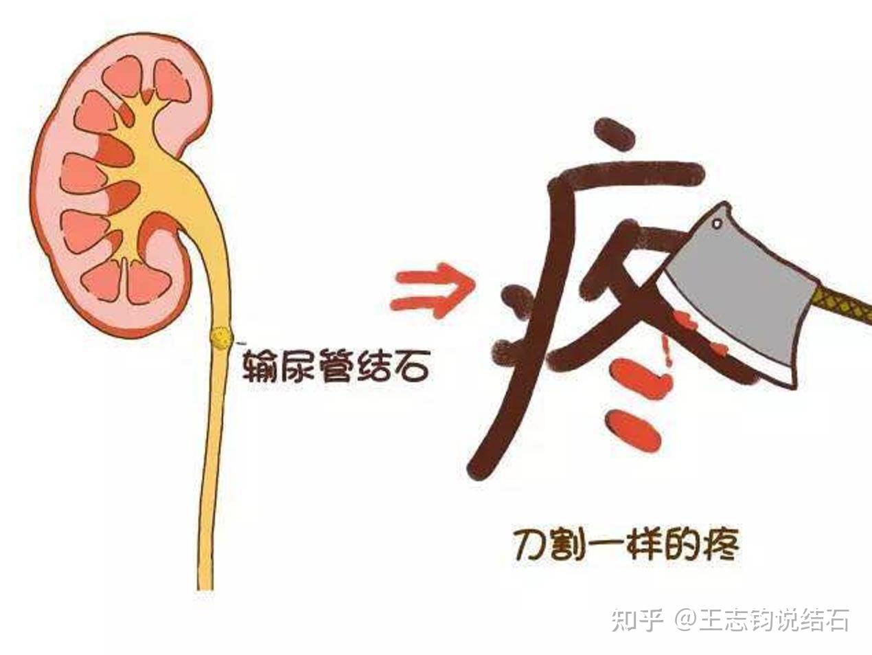 尿血不可不提防輸尿管結石