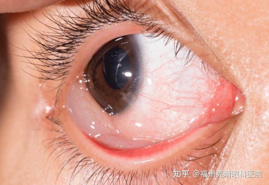 孩子眼睛痒,还伴有发红,流泪,眼科医生:过敏性结膜炎!