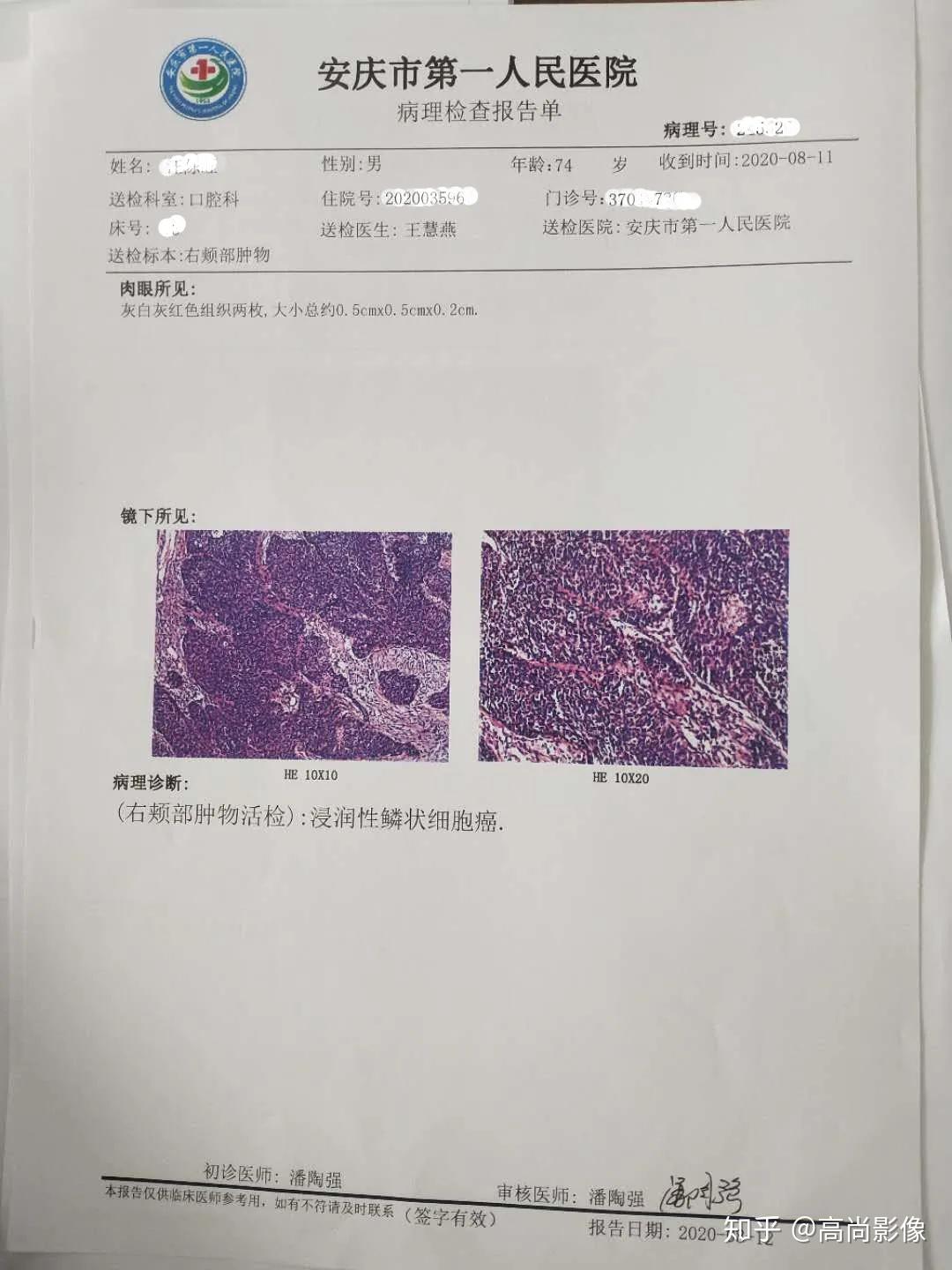 西安高尚医学影像诊断中心病例口腔鳞状细胞癌2例