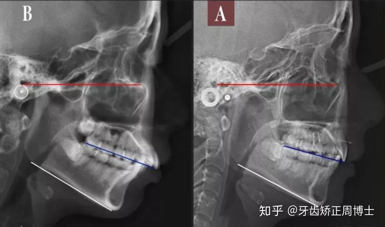 骨性龅牙侧面x光片图片