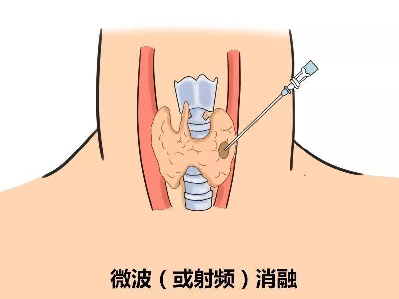 做甲状腺穿刺需要多长时间?甲状腺穿刺的伤害大么?