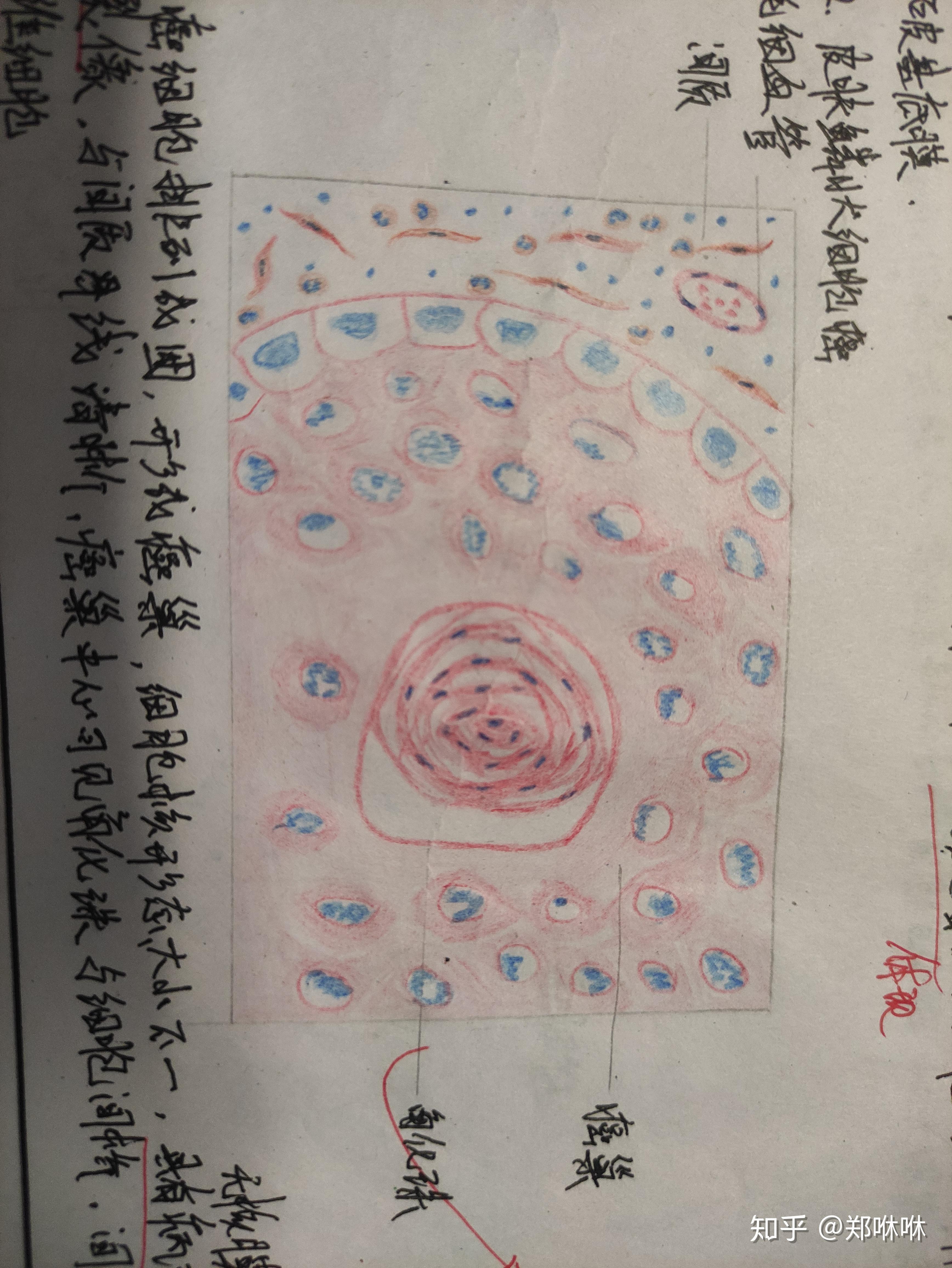 朗格汉斯细胞红蓝铅笔图片