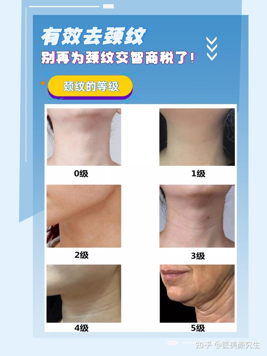如今韩国可以通过颈纹手术来消灭颈纹 - 知乎