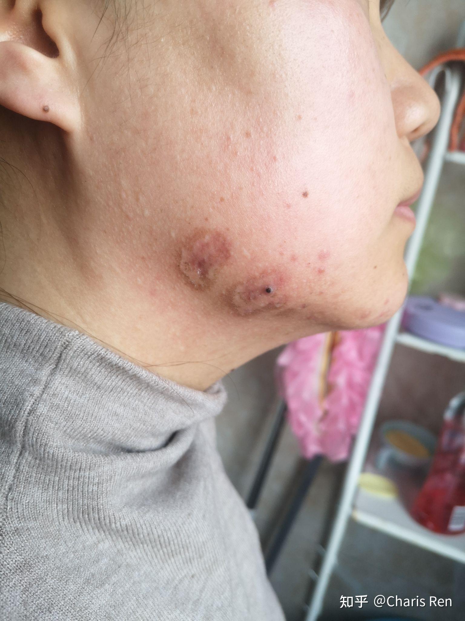 今天挂了主治医生的号,帮我伤口清洗了一下,血痂清理了,可以看出洞眼