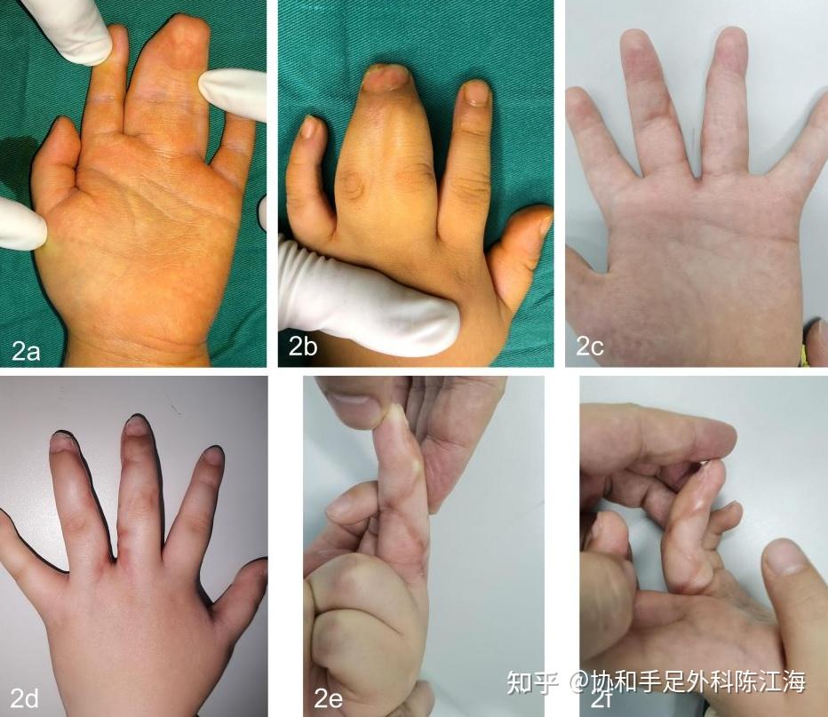 免植皮并指分离案例三免植皮并指分离案例四免植皮并指分离案例五先天