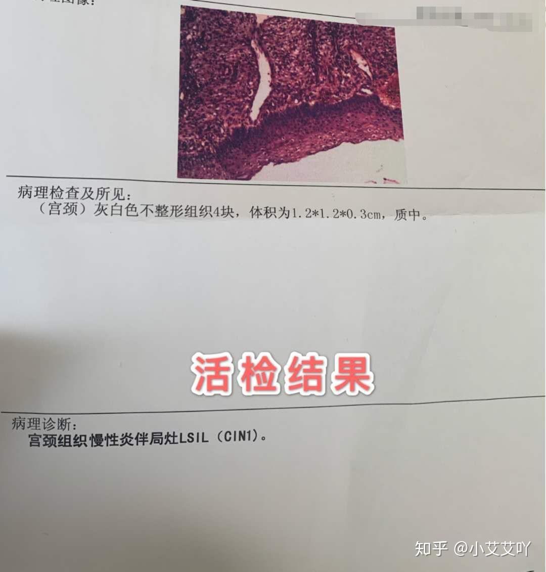 hpv高低危混合感染宮頸癌前病變四個月轉陰記錄