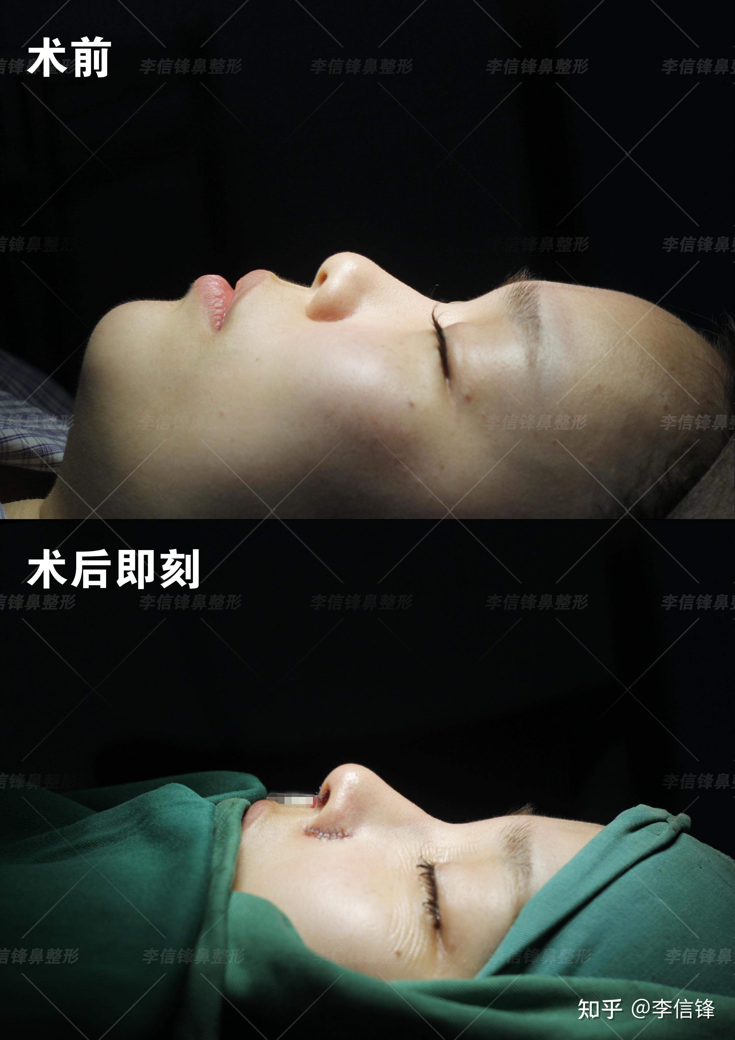 填充鼻基底好吗_鼻基底填充大概多少钱_填充鼻基底可以维持多久