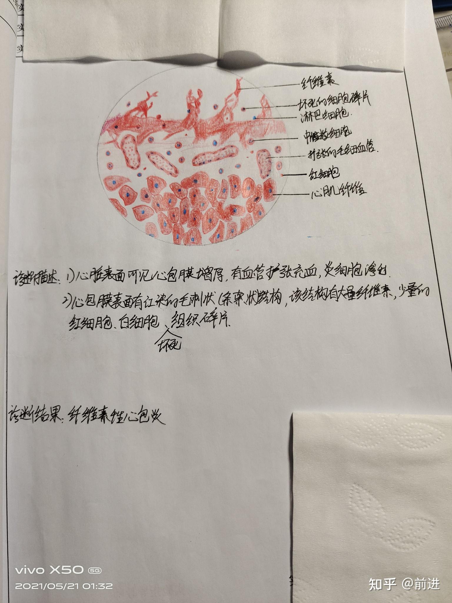 5纤维素性心包炎4混合血栓3慢性肺淤血2肝脂肪变性