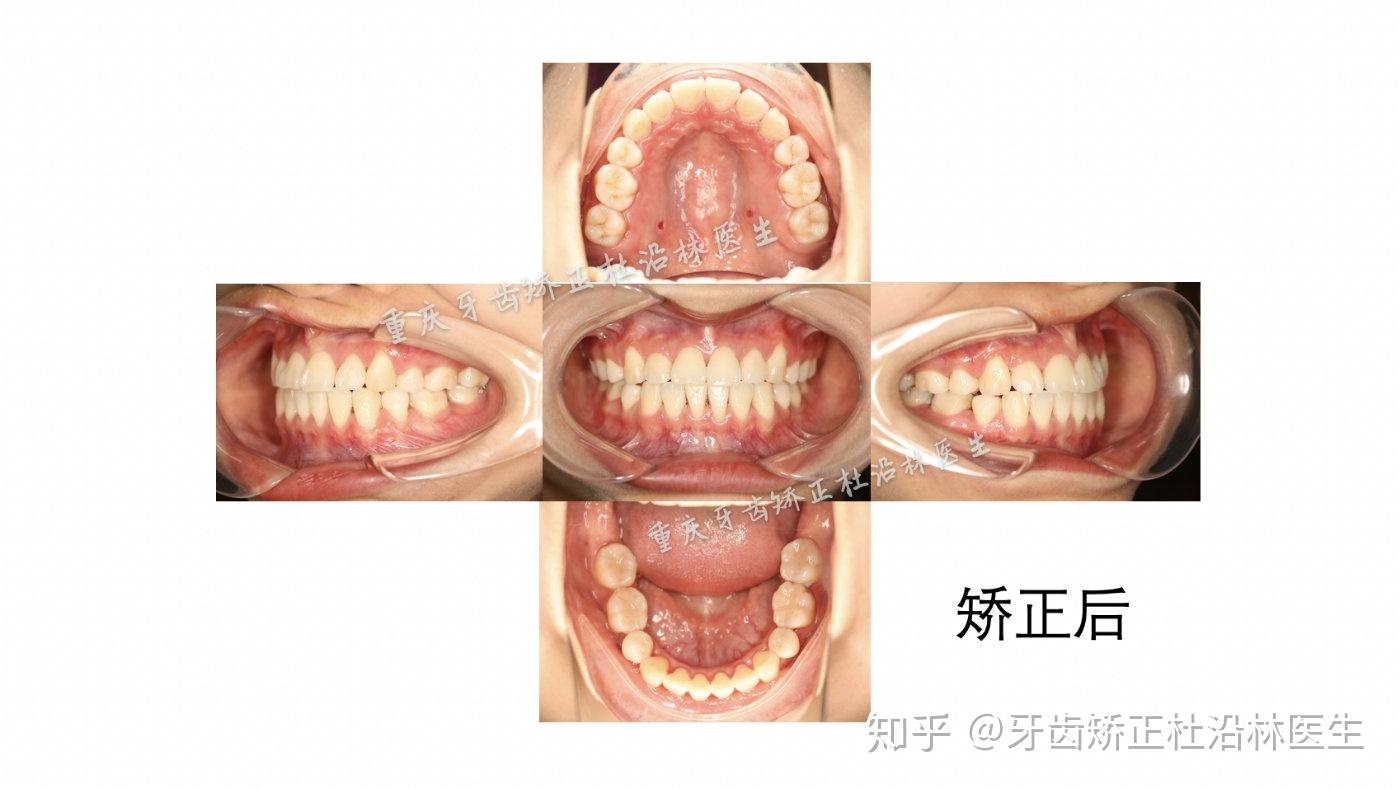 重慶牙齒矯正丨二次矯正內收牙齒改善咬合重塑側顏