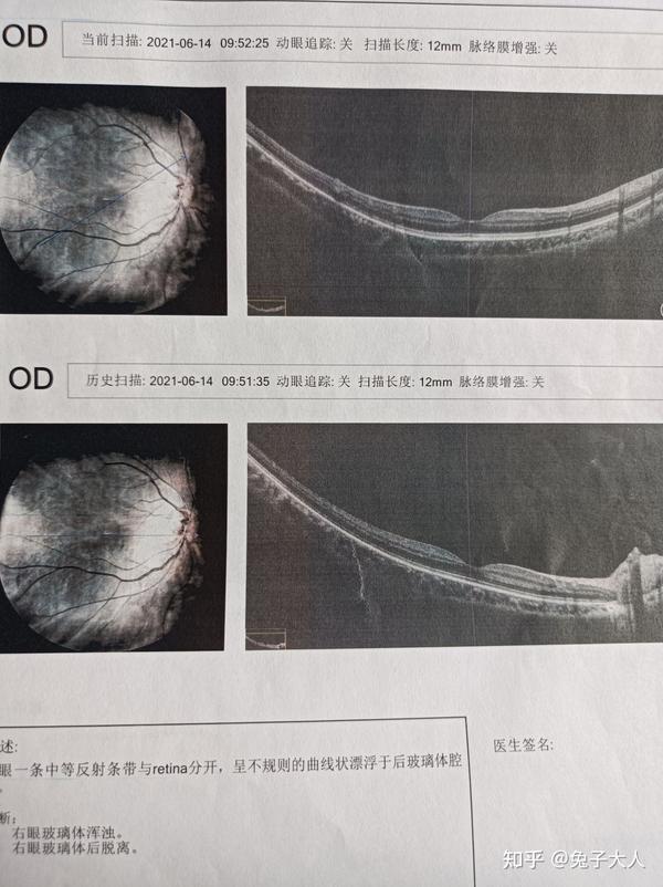 一个玻璃体后脱离闪光和飞蚊症患者的困惑 知乎