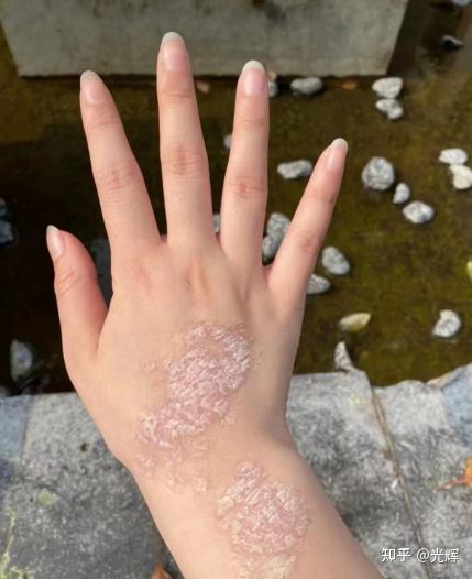我后背用激素药膏留下了很多黑色斑块(桑心)看着一点点变化的手背我