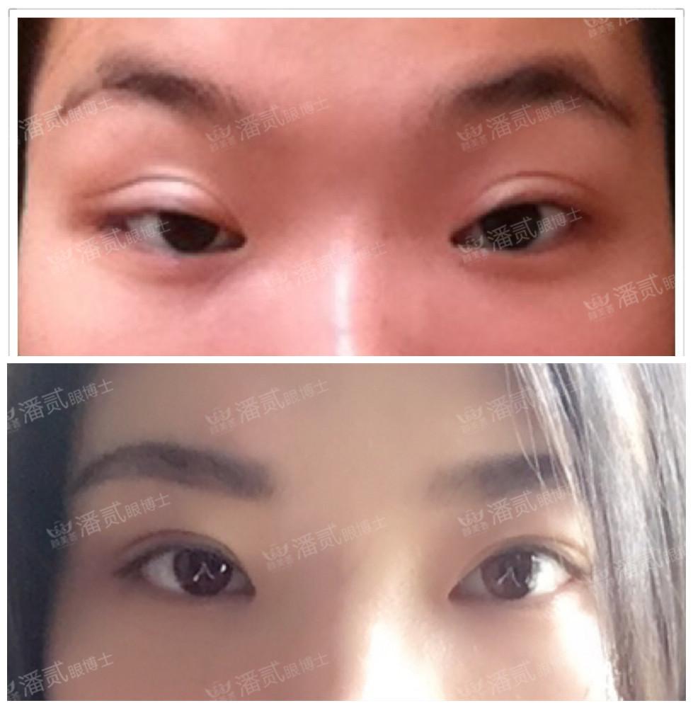重度上睑下垂的人眉毛像张飞埋线可以提肌外眼角下至可以做吗