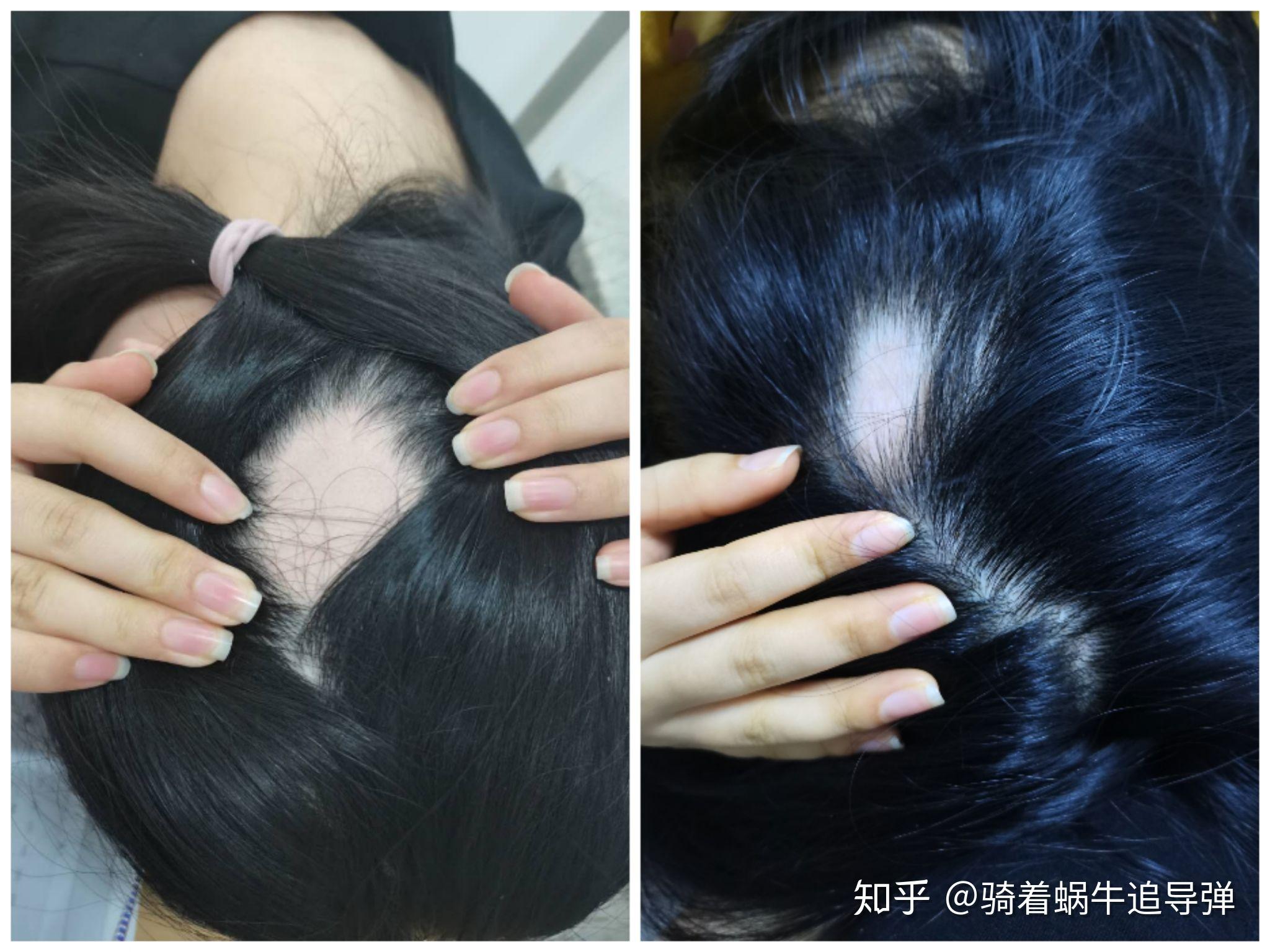 我的斑秃恢复历程 - 知乎