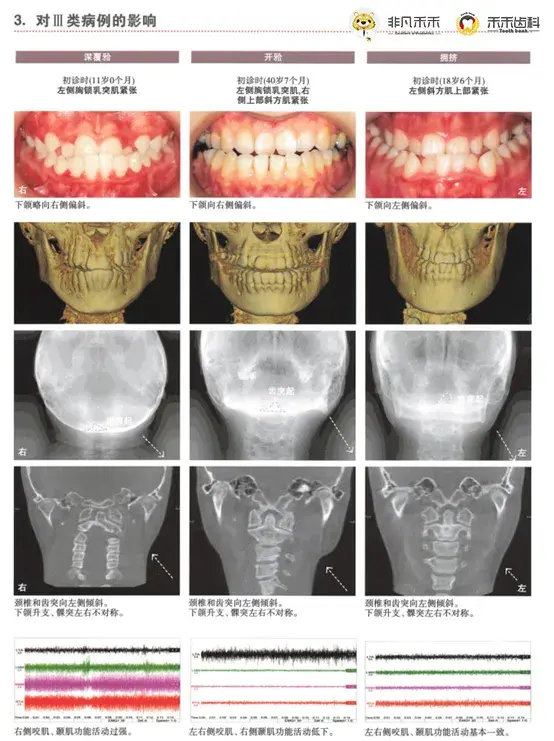 正畸科普 颈部肌肉异常对颌面部骨骼会造成什么影响 知乎