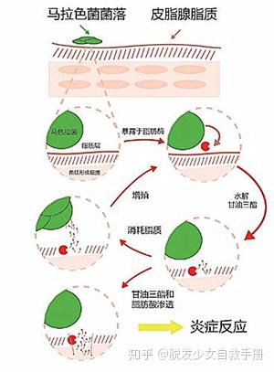 头皮越挠越痒?找到根源搞定头痒难题! - 知乎
