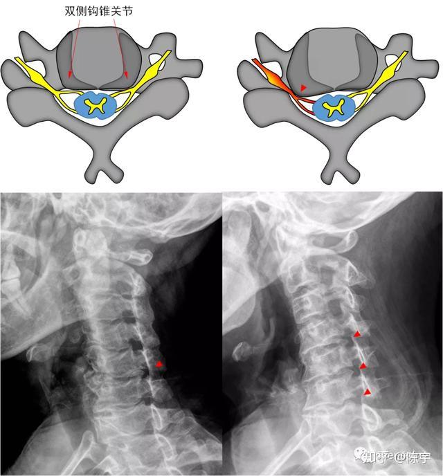 致病因素,因此提出以切除luschka关节增生为目的前路经椎间隙扩大减