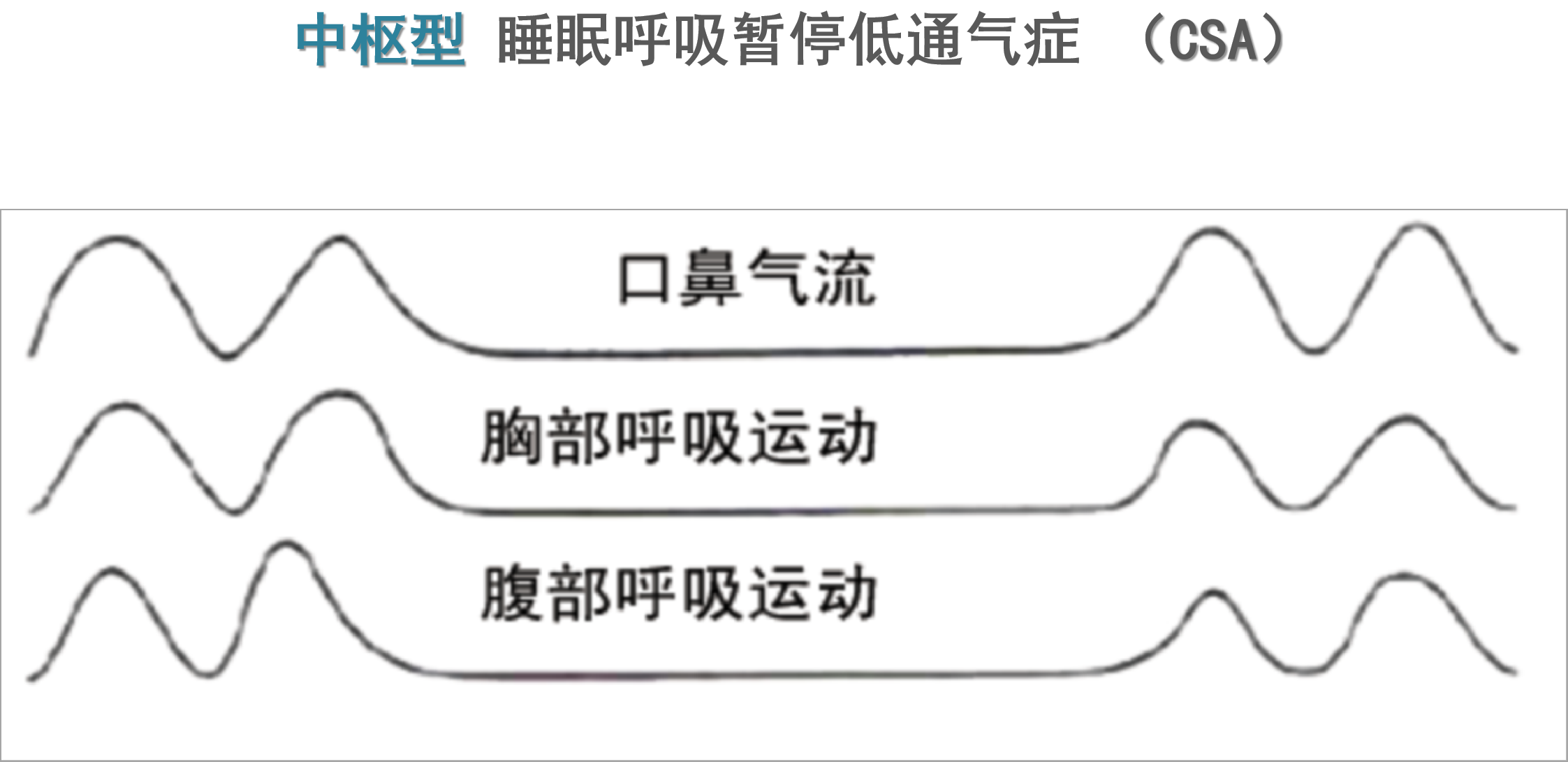 睡眠呼吸暂停综合症的种类你了解吗?一起来看看吧! 