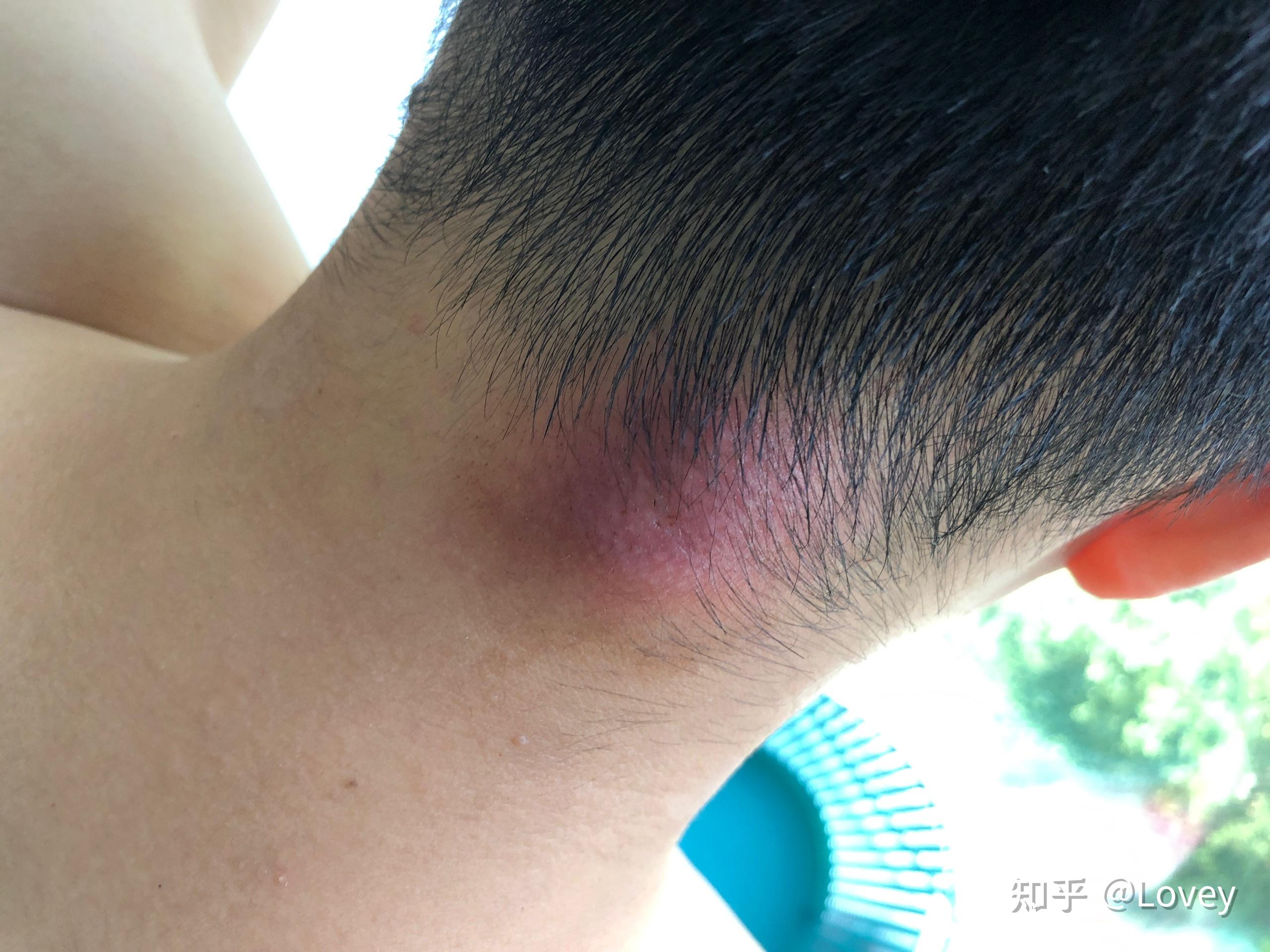 记一次疖肿(痈)切开引流手术经历 - 知乎