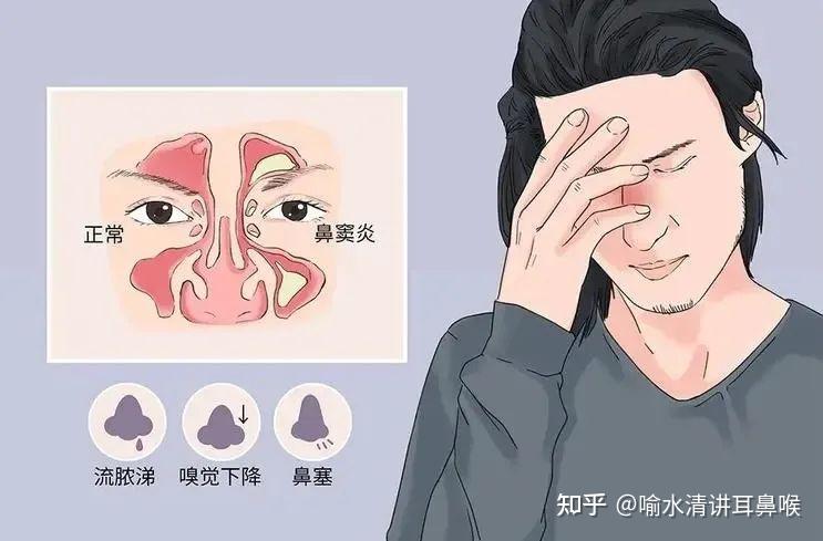 什么叫副鼻窦炎 zhuanlan.zhihu.com