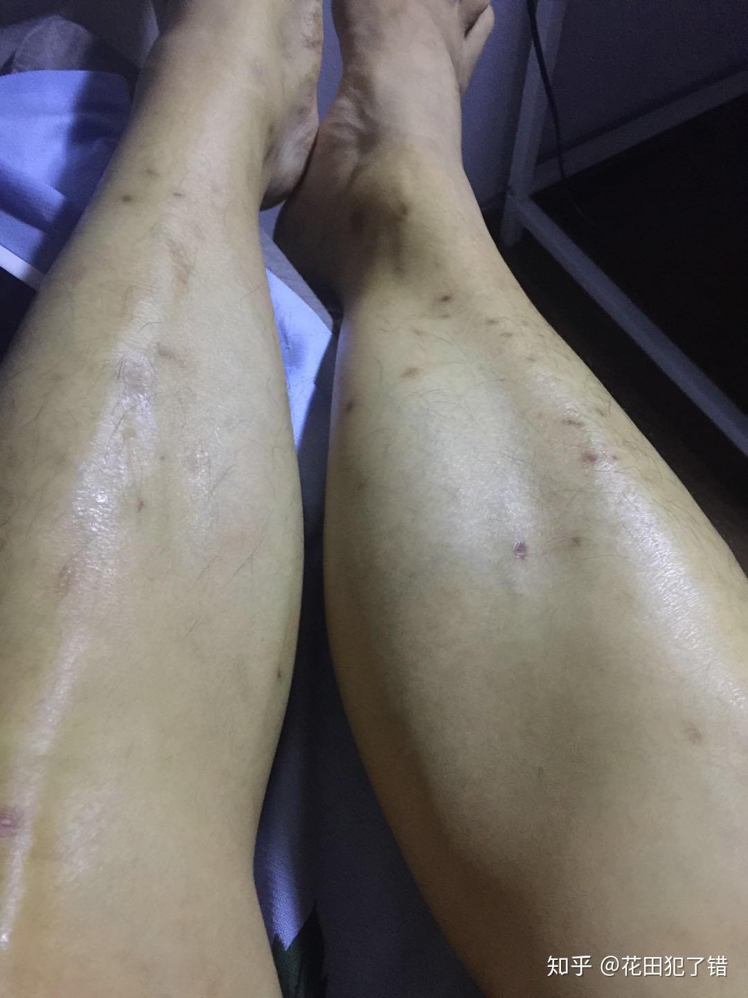 满腿的疤痕怎么消除实测