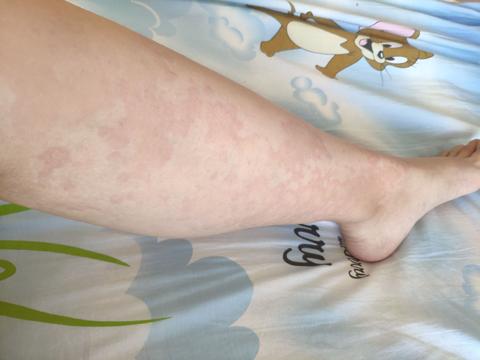 阿莫西林过敏 就是内种感冒了或者别的病常吃的阿莫西林 可怕的是我