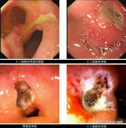 人愤怒或者紧张时,胃酸会大量分泌,过量的胃酸会损伤黏膜,引起胃黏膜