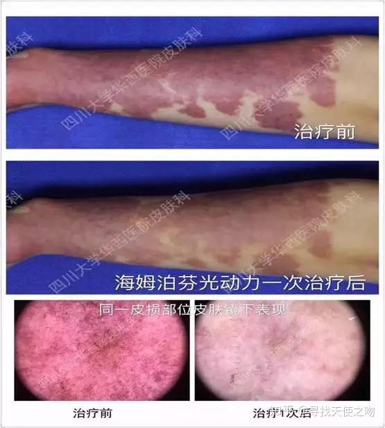 战斗四肢部位大面积鲜红斑痣光动力技术疗效专题展示