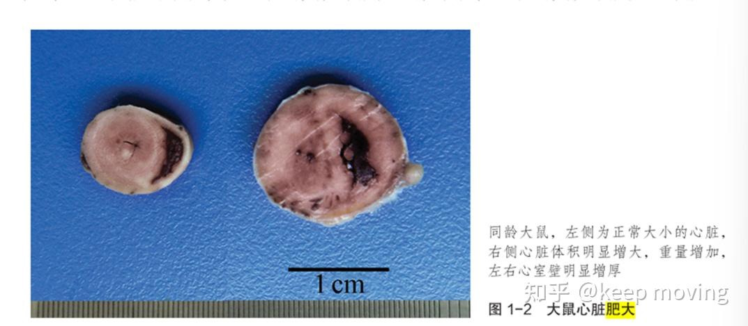 心脏组织常见病理变化 - 知乎