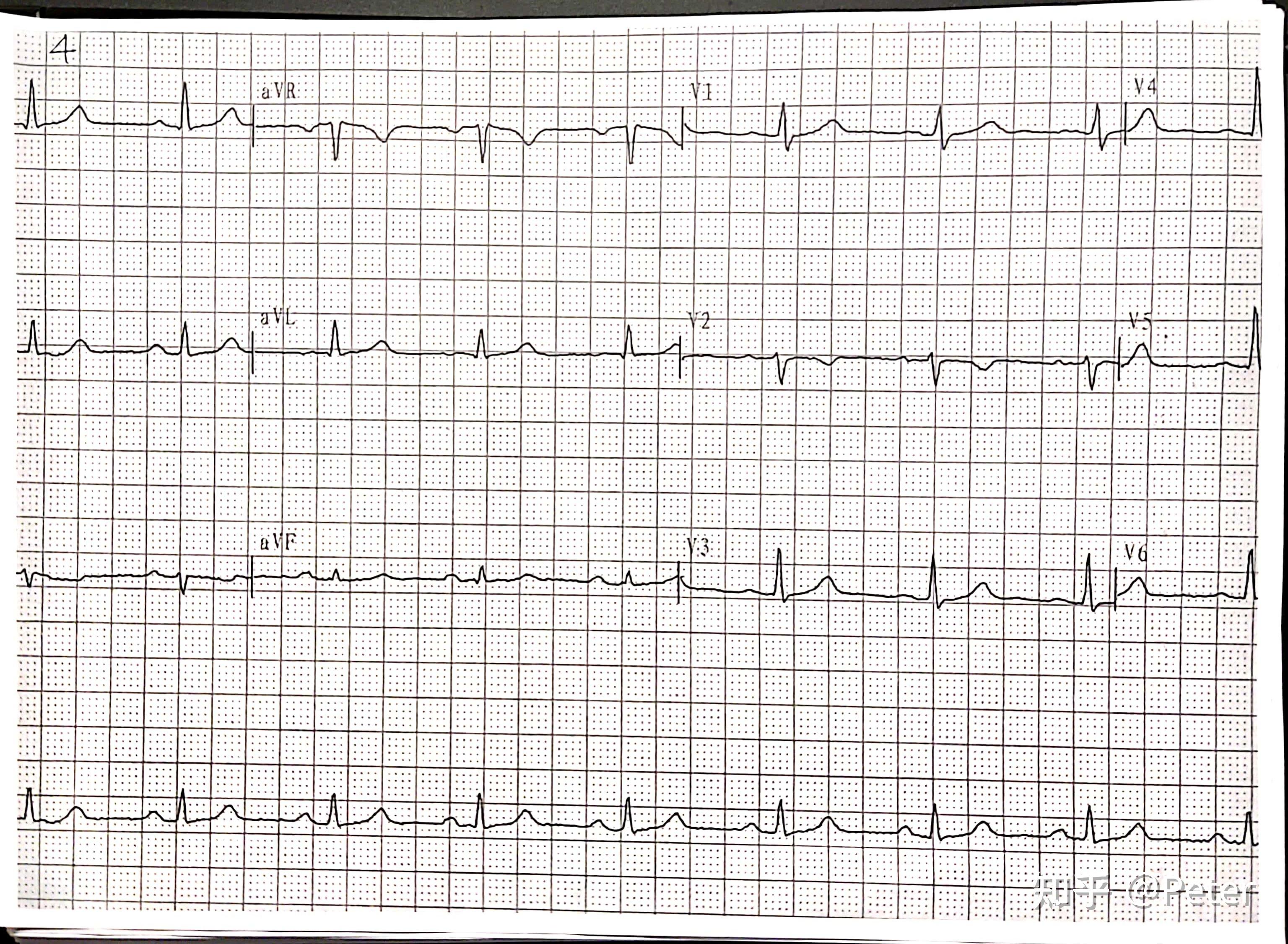 avl,avr的图形互换;avf正常;v1-v6导联r波逐渐减小,s波逐渐加深,成rs
