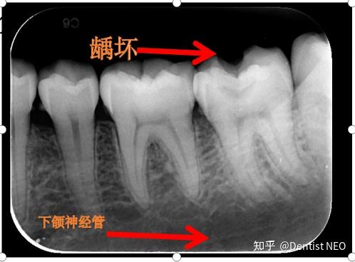 一分钟教你看懂根尖片