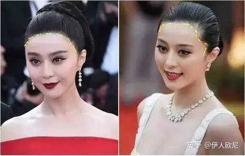 女生发际线后移怎么办