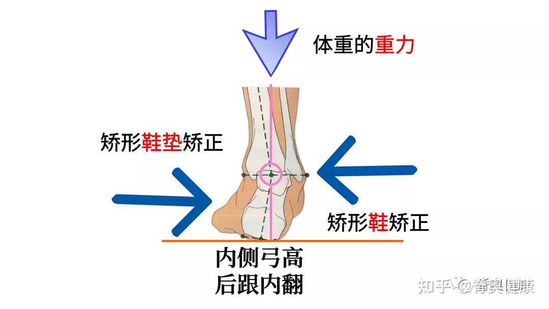 高弓足矫形鞋垫是基于哪些生物力学原理制作?