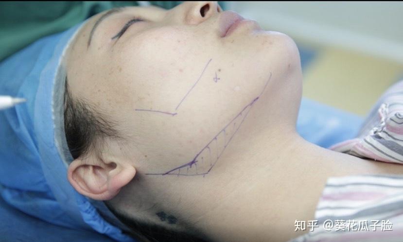 怎么拥有清晰的下颌角 v2-6307cf1ab03bfc13f9927d6361b21ab7_r.jpg