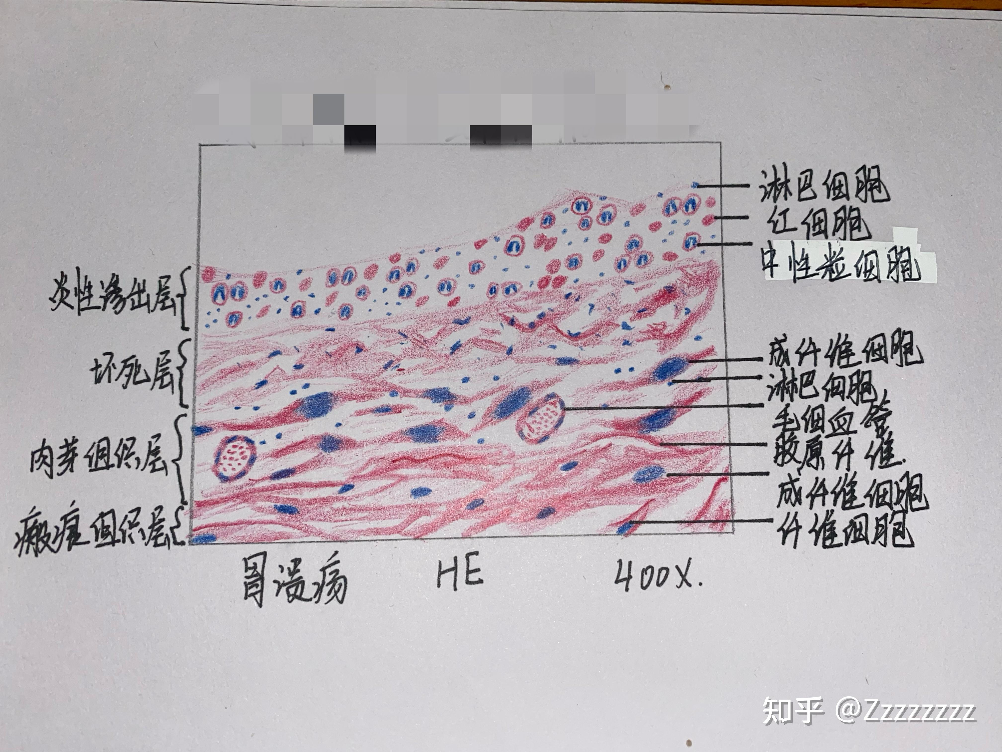 子宫平滑肌瘤红蓝绘图图片