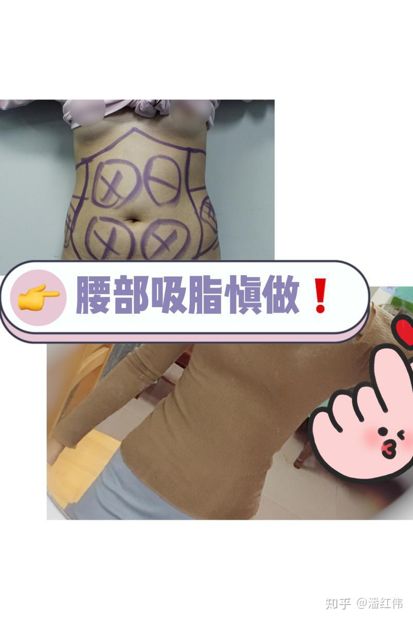 艾米丽潘红伟院长慎腰部吸脂有毒真的会上瘾