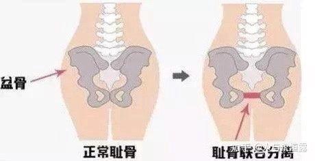 骨盆痛是什么症状 v2-6325799bf9e7e97b098c18104a355087_r.jpg