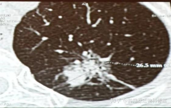 PET-CT报告单怎么看？呼吸科医生这样看PET-CT报告，事半功倍！ - 知乎