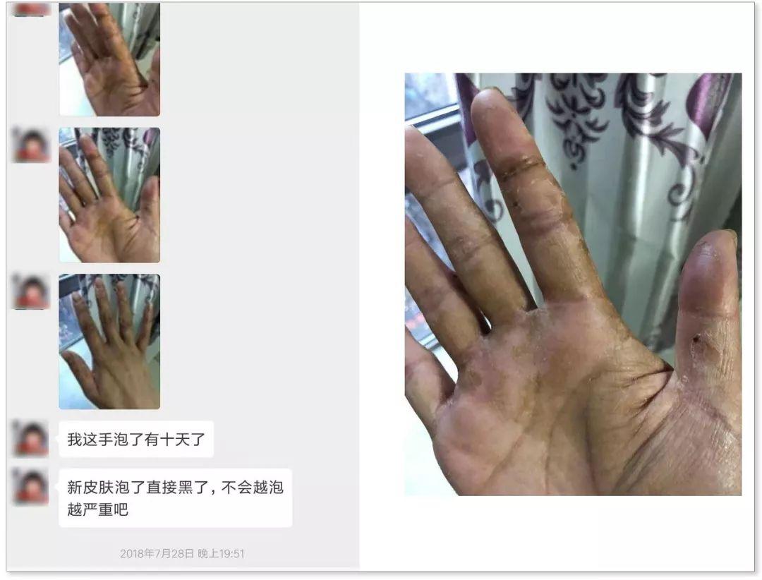 手指真菌感染图片_100种皮肤病对照图_微信公众号文章