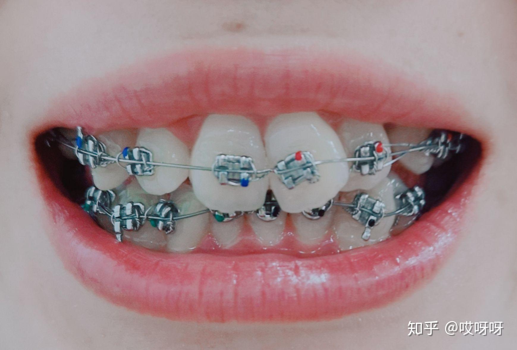 正畸分享虎牙埋伏牙