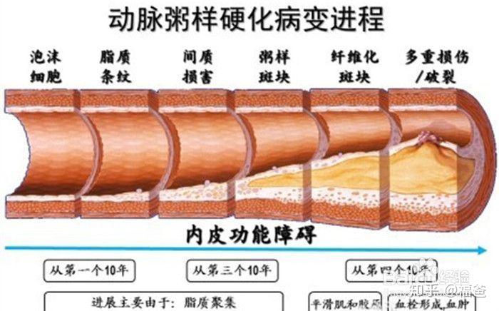 血管堵塞程度图片