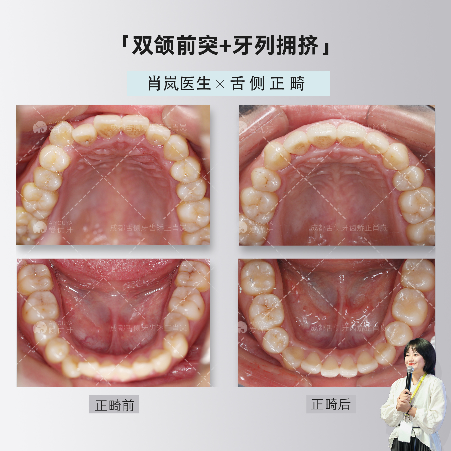 牙齿矫正侧面对比图片