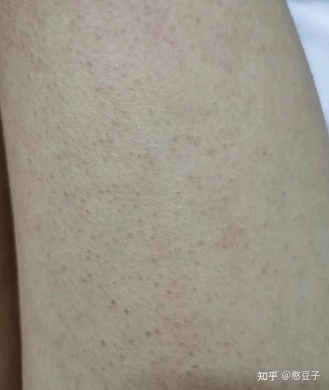 肚子变成鸡皮肤(皮肤怎么会变成鸡皮肤)