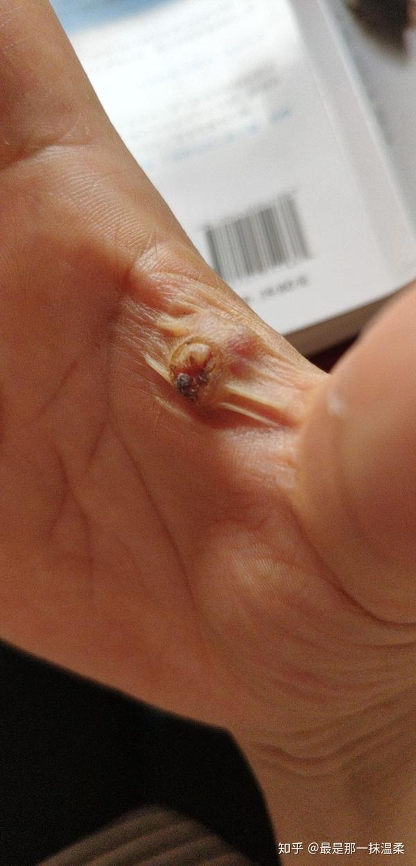 化脓性肉芽肿 - 知乎