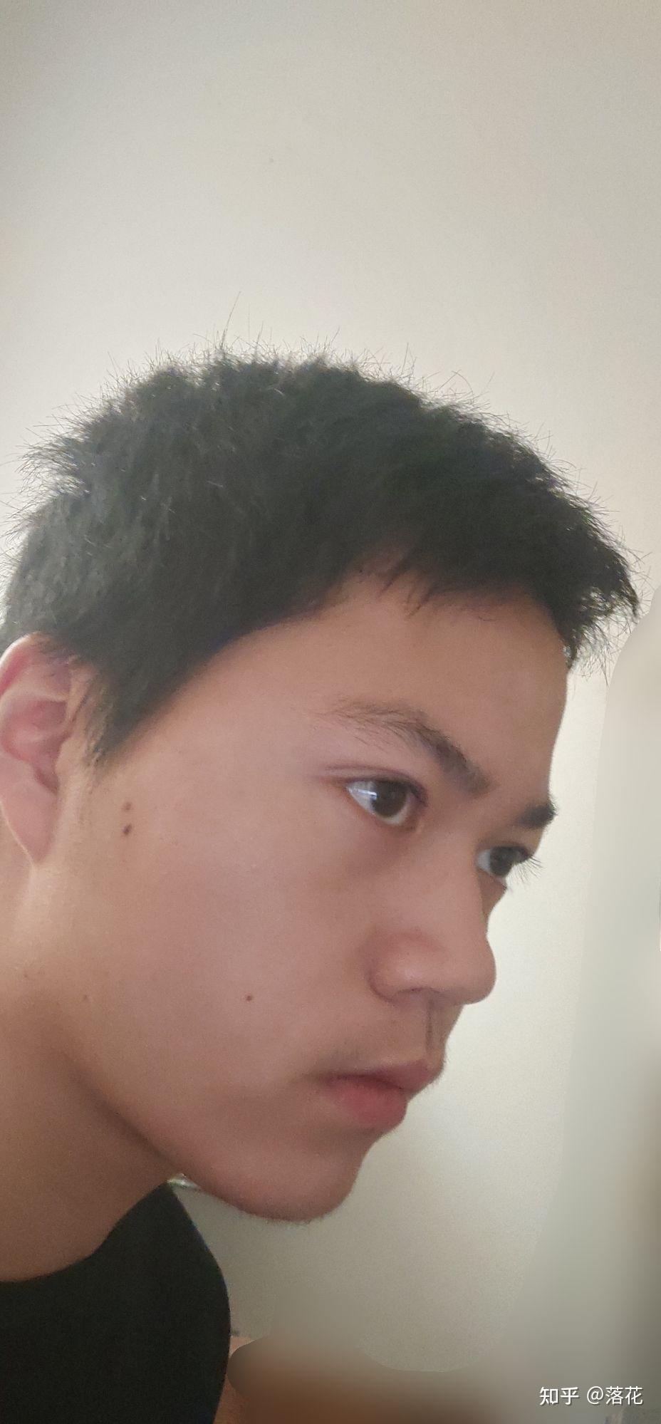 后置脸歪眼斜和鼻山根低鼻翼大